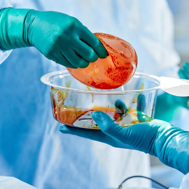 immagine desktop Protesi mammarie e linfoma, le evidenze scientifiche a supporto della correlazione sono limitate